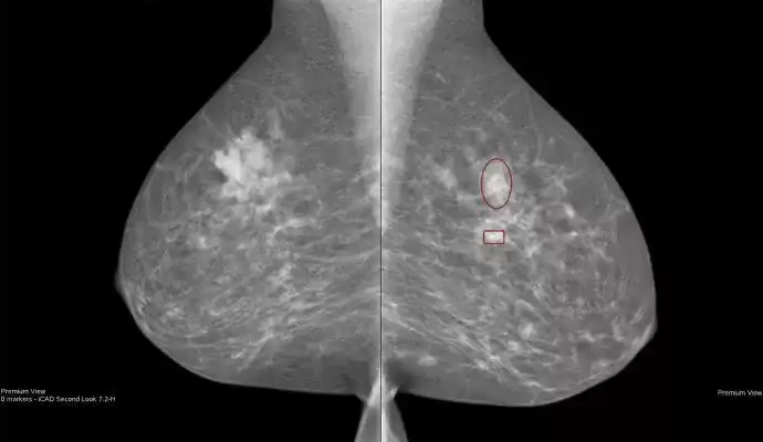 ProFound AI for 2D Mammography